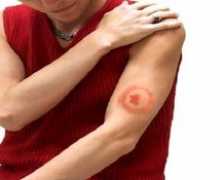 Klíčová charakteristika klíšťovité boreliózy, metody léčby