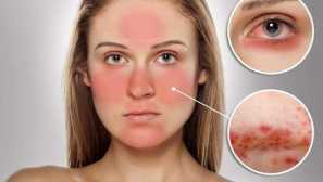 Subkutánní klíště v přízrakech, léčbě a prevenci!